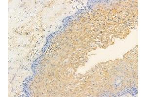 ABIN6256645 and ABIN6267481 at 1/100 staining human cervical carcinoma by IHC-P. (NOS2 抗体  (pTyr151))