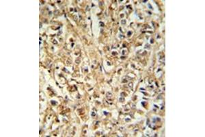 Formalin fixed, paraffin embedded breast carcinoma reacted with DDX6 Antibody (Center) followed by peroxidase conjugation of the secondary antibody and DAB staining. (DDX6 抗体  (Middle Region))