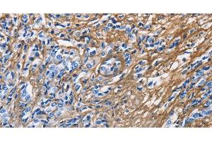 Immunohistochemistry of paraffin-embedded Human prostate cancer tissue using COL3A1 Polyclonal Antibody at dilution 1:60 (COL3A1 抗体)