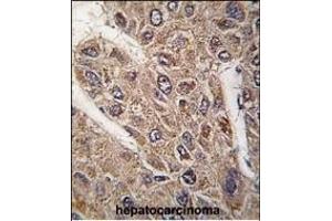 Formalin-fixed and paraffin-embedded human hepatocarcinoma tissue reacted with BICD2 antibody (C-term) (ABIN392178 and ABIN2841891) , which was peroxidase-conjugated to the secondary antibody, followed by DAB staining. (BICD2 抗体  (C-Term))