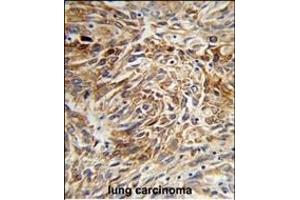 Formalin-fixed and paraffin-embedded human lung carcinoma reacted with AGR3 Antibody (C-term), which was peroxidase-conjugated to the secondary antibody, followed by DAB staining.
