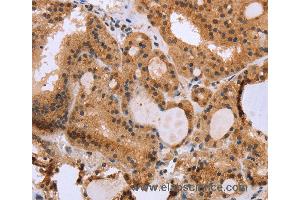 Immunohistochemistry of Human thyroid cancer using EPDR1 Polyclonal Antibody at dilution of 1:40 (EPDR1 抗体)