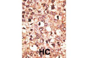 Formalin-fixed and paraffin-embedded human hepatocellular carcinoma tissue reacted with CRY1 polyclonal antibody  , which was peroxidase-conjugated to the secondary antibody, followed by AEC staining. (CRY1 抗体  (C-Term))