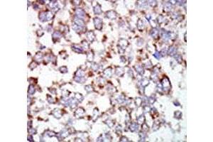 IHC analysis of FFPE human hepatocarcinoma tissue stained with the TAK1 antibody (TR4 抗体  (AA 574-606))
