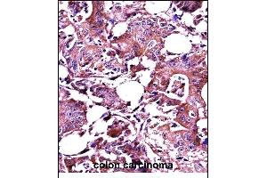 LGALS3 Antibody (C-term) ((ABIN657647 and ABIN2846642))immunohistochemistry analysis in formalin fixed and paraffin embedded human colon carcinoma followed by peroxidase conjugation of the secondary antibody and DAB staining. (Galectin 3 抗体  (C-Term))
