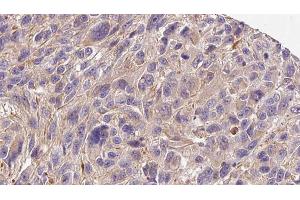 ABIN6272278 at 1/100 staining Human Melanoma tissue by IHC-P. (COL4a6 抗体  (Internal Region))