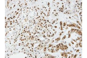 IHC-P Image Immunohistochemical analysis of paraffin-embedded A549 xenograft, using SOCS3, antibody at 1:100 dilution. (SOCS3 抗体  (C-Term))