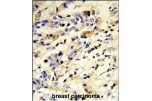 Formalin-fixed and paraffin-embedded human breast carcinoma reacted with IGHM Antibody (N-term), which was peroxidase-conjugated to the secondary antibody, followed by DAB staining.