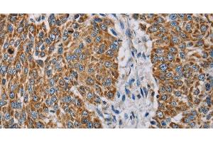 Immunohistochemistry of paraffin-embedded Human lung cancer using MTFP1 Polyclonal Antibody at dilution of 1:30 (Mtfp1 抗体)