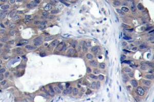 Immunohistochemistry (IHC) analyzes of IRS-1 antibdoy in paraffin-embedded human breast carcinoma tissue. (IRS1 抗体)