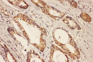 Anti-RAB8A antibody, IHC(P) IHC(P): Human Intestinal Cancer Tissue (RAB8A 抗体  (C-Term))
