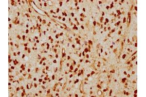 IHC image of ABIN7127601 diluted at 1:115 and staining in paraffin-embedded human glioma cancer performed on a Leica BondTM system. (Recombinant Lamin A/C 抗体)