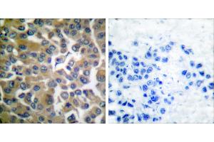 Peptide - +Immunohistochemical analysis of paraffin-embedded human breast carcinoma tissue, using FAP-1 antibody. (FAP 抗体)