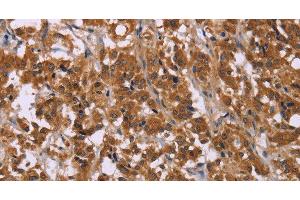 Immunohistochemistry of paraffin-embedded Human thyroid cancer using CMTM6 Polyclonal Antibody at dilution of 1:30 (CMTM6 抗体)