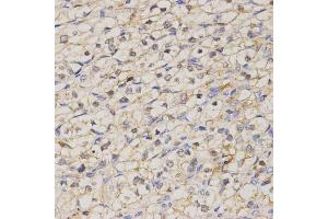 Immunohistochemistry of paraffin-embedded human kidney cancer using GJC2 antibody (ABIN5971490) at dilution of 1/200 (40x lens). (GJC2 抗体)