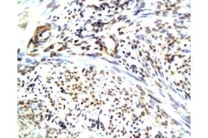 Formalin-fixed and paraffin embedded human endometrium carcinoma with Anti-CGRP/CGRP2 Polyclonal Antibody, Unconjugated (ABIN728218) at 1:200, followed by conjugation to the secondary antibody and DAB staining (CGRP 抗体  (AA 65-130))