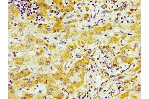 Immunohistochemistry of paraffin-embedded human liver cancer using ABIN7170696 at dilution of 1:100 (SND1 抗体  (AA 560-732))