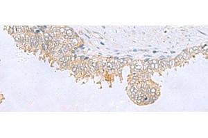 Immunohistochemistry of paraffin-embedded Human prost ate cancer tissue using GPCPD1 Polyclonal Antibody at dilution of 1:55(x200) (GPCPD1 抗体)