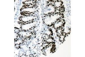 Immunohistochemical analysis of HNF4 alpha (pS313) staining in human colon cancer formalin fixed paraffin embedded tissue section. (HNF4A 抗体  (pSer313))