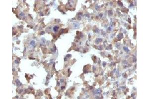 Formalin-fixed, paraffin-embedded human Histiocytoma stained with TNF alpha antibody (TNFA/1172) (TNF alpha 抗体)