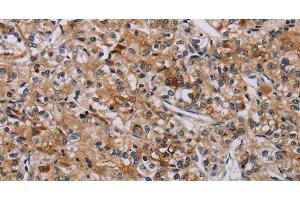 Immunohistochemistry of paraffin-embedded Human prostate cancer tissue using AATK Polyclonal Antibody at dilution 1:45 (AATK 抗体)