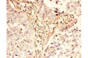 IHC-P: LIF antibody testing of human lung cancer tissue (LIF 抗体  (AA 23-202))