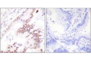 Immunohistochemistry analysis of paraffin-embedded human lung carcinoma tissue, using p300 Antibody. (p300 抗体  (AA 1-50))