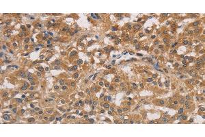 Immunohistochemistry of paraffin-embedded Human thyroid cancer tissue using DSTN Polyclonal Antibody at dilution 1:30 (Destrin 抗体)