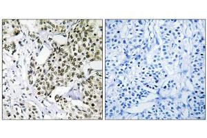 Immunohistochemistry analysis of paraffin-embedded human breast carcinoma tissue using CAGE1 antibody. (CAGE1 抗体  (C-Term))