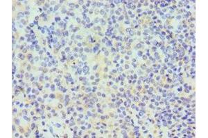 Immunohistochemistry of paraffin-embedded human breast cancer using ABIN7171508 at dilution of 1:100 (TARDBP 抗体  (AA 1-260))