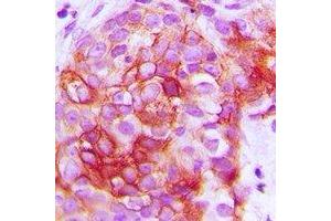 Immunohistochemical analysis of GIP Receptor staining in human breast cancer formalin fixed paraffin embedded tissue section. (GIPR 抗体)
