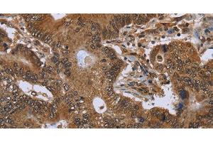 Immunohistochemistry of paraffin-embedded Human colon cancer using FHIT Polyclonal Antibody at dilution of 1:30 (FHIT 抗体)