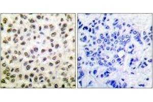 Immunohistochemistry analysis of paraffin-embedded human breast carcinoma tissue, using STAT5B (Ab-731) Antibody. (STAT5B 抗体  (AA 697-746))