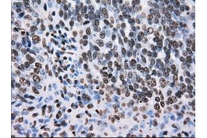 Immunohistochemical staining of paraffin-embedded colon tissue using anti-TTLL12mouse monoclonal antibody. (TTLL12 抗体)