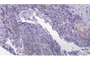 ABIN6279509 at 1/100 staining Human Head and neck cancer tissue by IHC-P. (KCNJ13 抗体  (Internal Region))