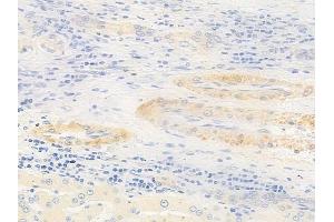 ABIN6258071 and ABIN6273747 at 1/100 staining human hepatocellular carcinoma by IHC-P.