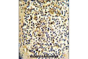 Formalin-fixed and paraffin-embedded human kidney carcinoma with DCXR Antibody , which was peroxidase-conjugated to the secondary antibody, followed by DAB staining. (Doublecortin 抗体  (AA 79-106))