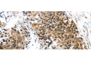 Immunohistochemistry of paraffin-embedded Human esophagus cancer tissue using TRIM74 Polyclonal Antibody at dilution 1:45 (TRIM74 抗体)