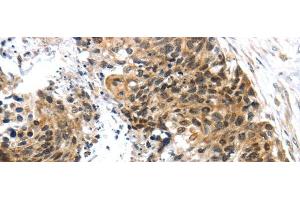 Immunohistochemistry of paraffin-embedded Human esophagus cancer tissue using TRIM74 Polyclonal Antibody at dilution 1:45 (TRIM74 抗体)