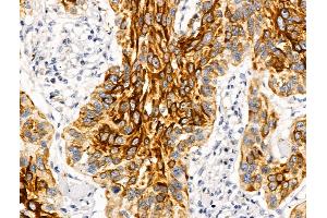 ABIN6262775 and ABIN6269025 at 1/100 staining Human esophageal cancer by IHC-P. (KRT16 抗体  (C-Term))