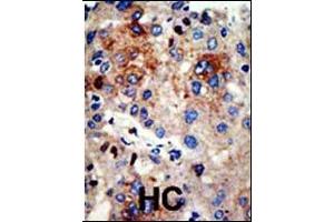 Formalin-fixed and paraffin-embedded human cancer tissue reacted with the primary antibody, which was peroxidase-conjugated to the secondary antibody, followed by AEC staining. (HDAC9 抗体  (N-Term))