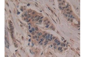 Detection of CD200 in Human Breast cancer Tissue using Polyclonal Antibody to Cluster Of Differentiation 200 (CD200)