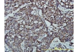 Immunoperoxidase of monoclonal antibody to GPR3 on formalin-fixed paraffin-embedded human transitional cell carcinoma tissue. (GPR3 抗体  (AA 1-330))