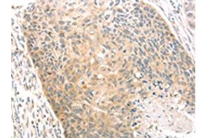The image on the left is immunohistochemistry of paraffin-embedded Human esophagus cancer tissue using ABIN7130971(SCAP Antibody) at dilution 1/20, on the right is treated with fusion protein. (SREBF chaperone 抗体)