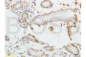 Formalin-fixed and paraffin embedded human colon carcinoma tissue labeled with Rabbit Anti-TEM1/CD248 Polyclonal Antibody (ABIN677573) at 1:200 followed by conjugation to the secondary antibody and DAB staining. (CD248 抗体  (AA 251-350))