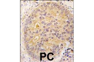 Formalin-fixed and paraffin-embedded human prostata carcinoma tissue reacted with CAMKK2 antibody , which was peroxidase-conjugated to the secondary antibody, followed by DAB staining. (CAMKK2 抗体  (N-Term))