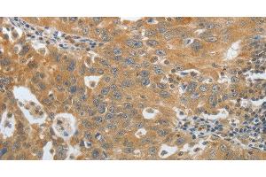 Immunohistochemistry of paraffin-embedded Human ovarian cancer using Amphiphysin I Polyclonal Antibody at dilution of 1:30 (Amphiphysin 抗体)