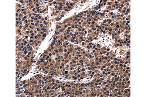 Immunohistochemistry of Human liver cancer using CUL4A Polyclonal Antibody at dilution of 1:62 (Cullin 4A 抗体)
