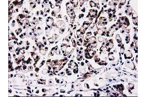 Immunohistochemical staining of paraffin-embedded Adenocarcinoma of Human colon tissue using anti-FAM40A mouse monoclonal antibody. (STRIP1 抗体)