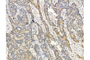 ABIN7095892 and ABIN7099954 at 1/100 staining human colorectal cancer by IHC-P.